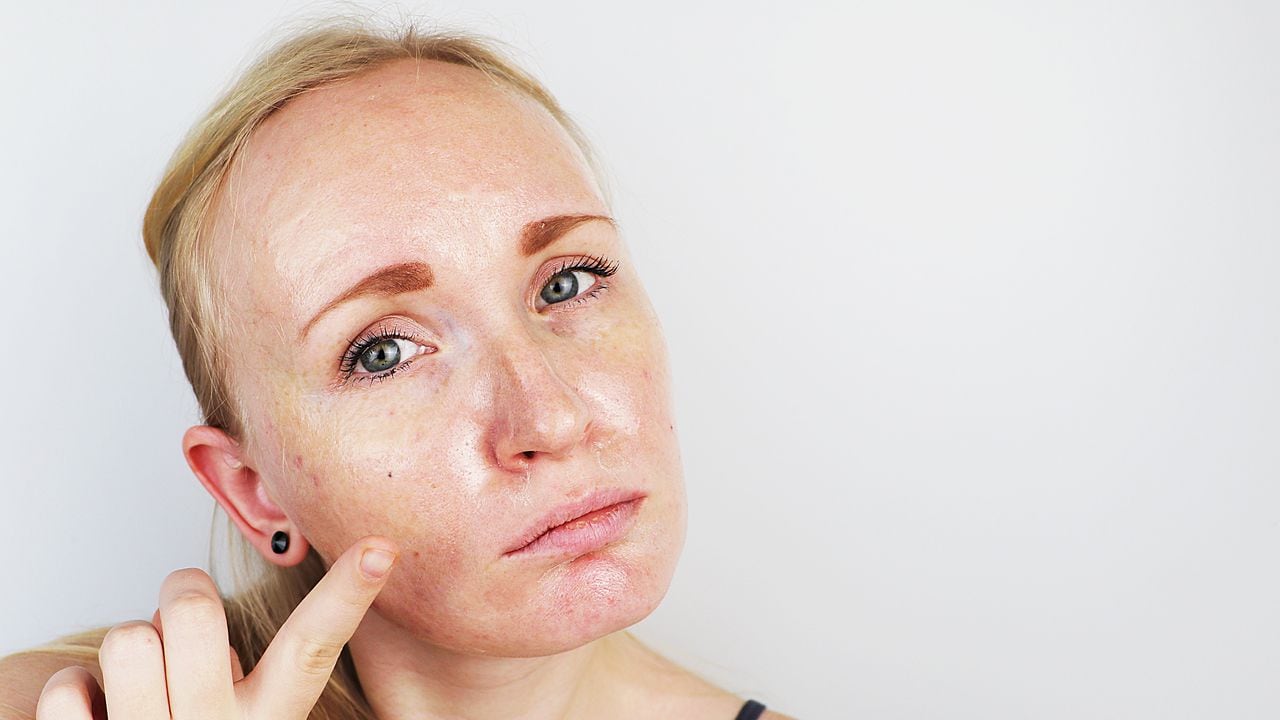 Eliminar la grasa de la cara: cuatro remedios caseros