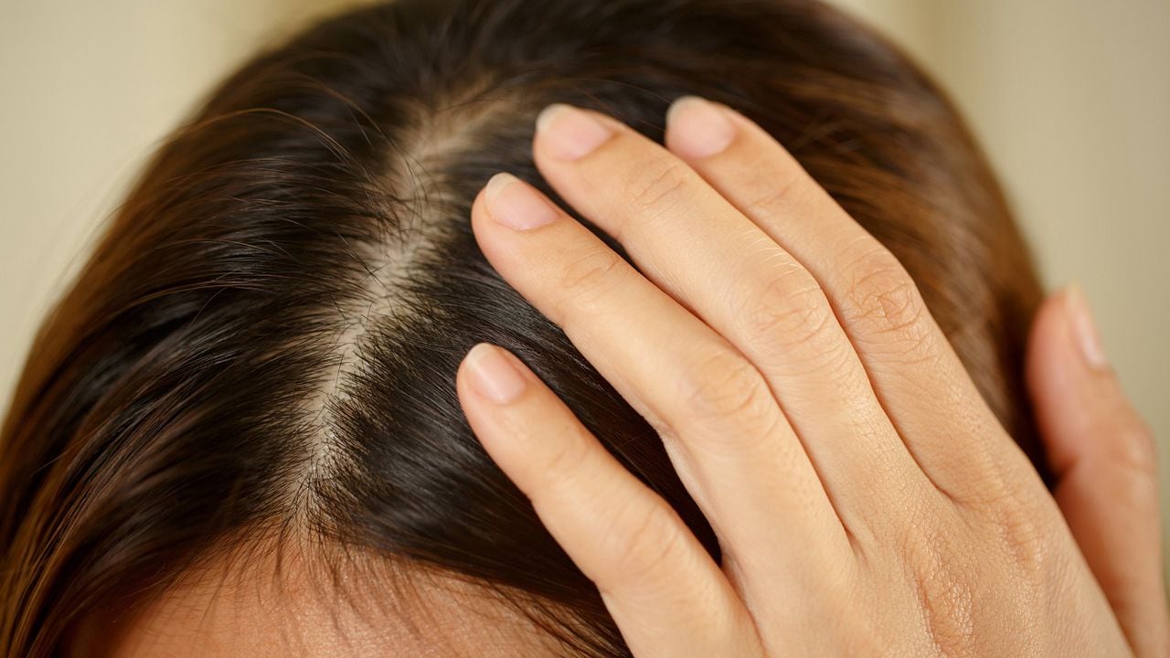 De nada Frenesí Maldito Remedio natural para quitar la resequedad del cuero cabelludo
