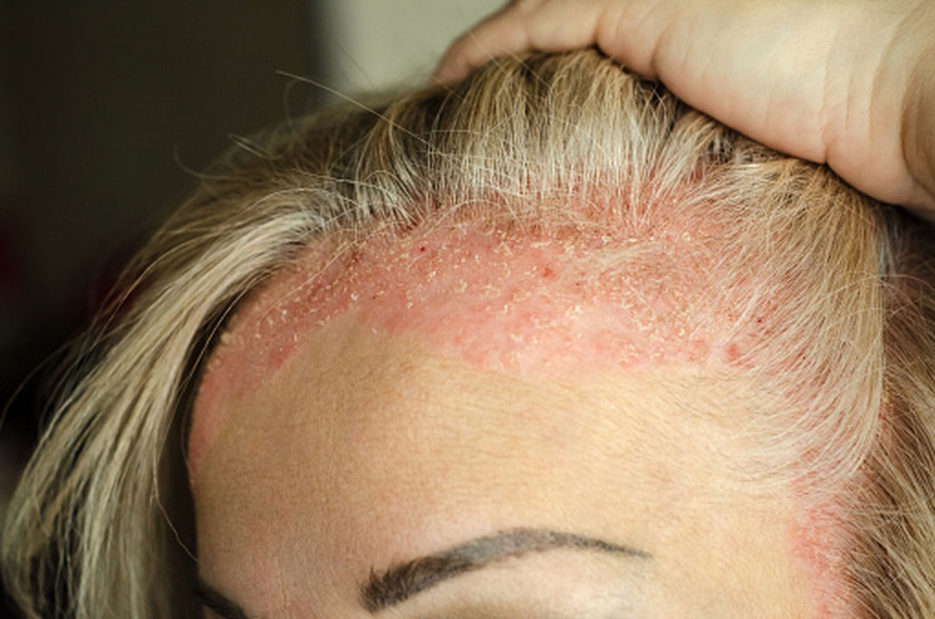 Psoriasis del cuero cabelludo: Champús y remedios caseros
