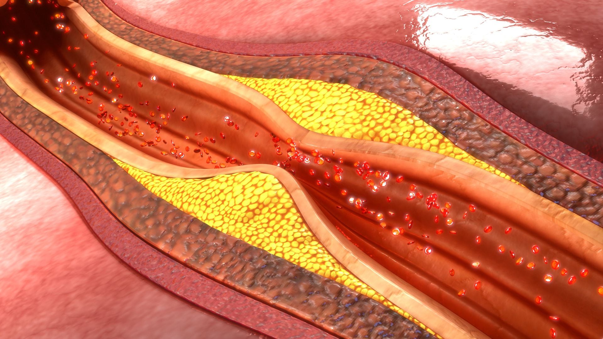 When cholesterol builds up in the arteries, the risk of heart disease increases.
