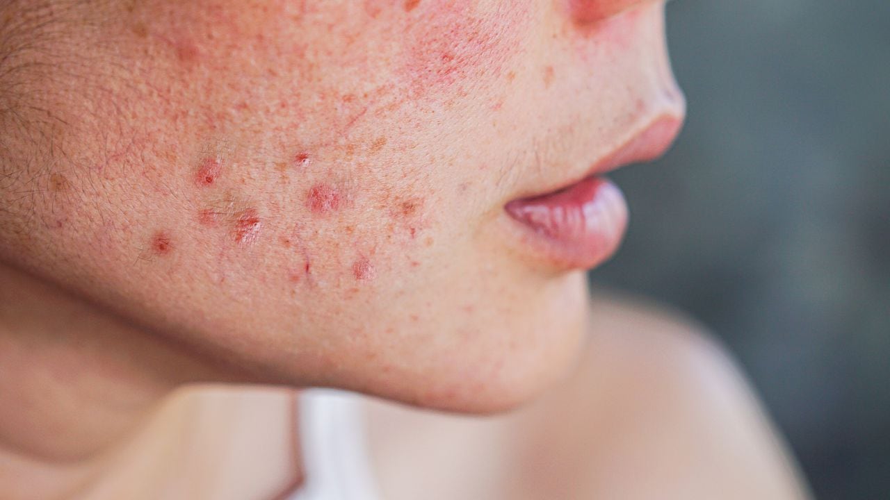 Estos son los mejores remedios caseros para curar el acné