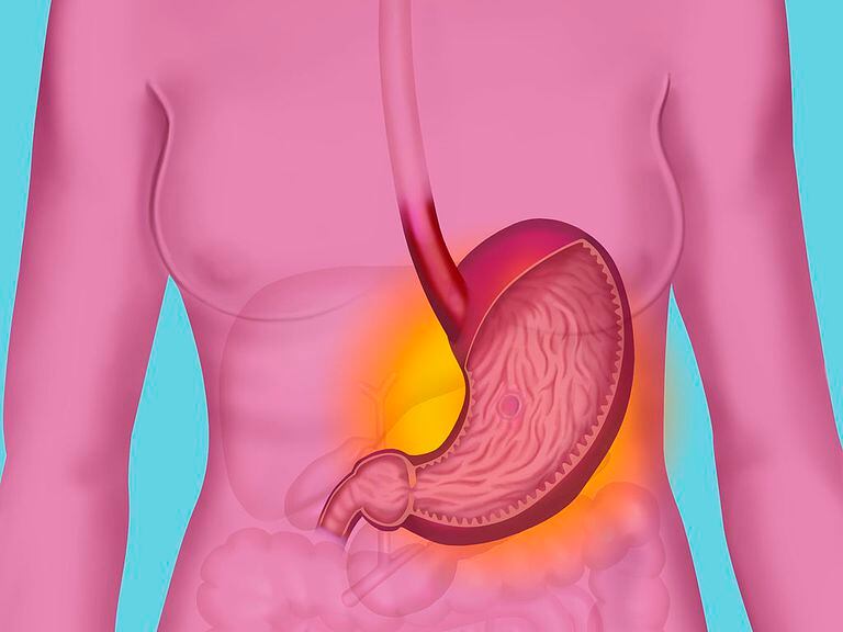 Cómo saber si tengo una úlcera gástrica o gastritis? - FCV