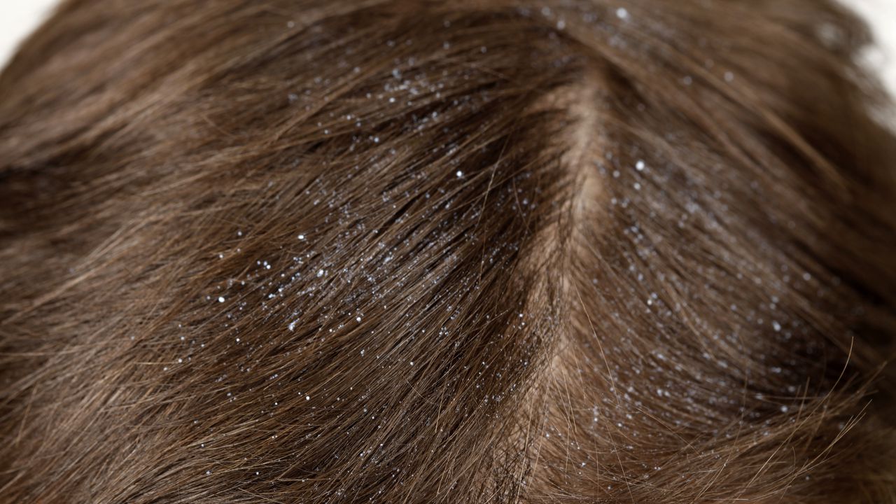 Psoriasis del cuero cabelludo: Champús y remedios caseros