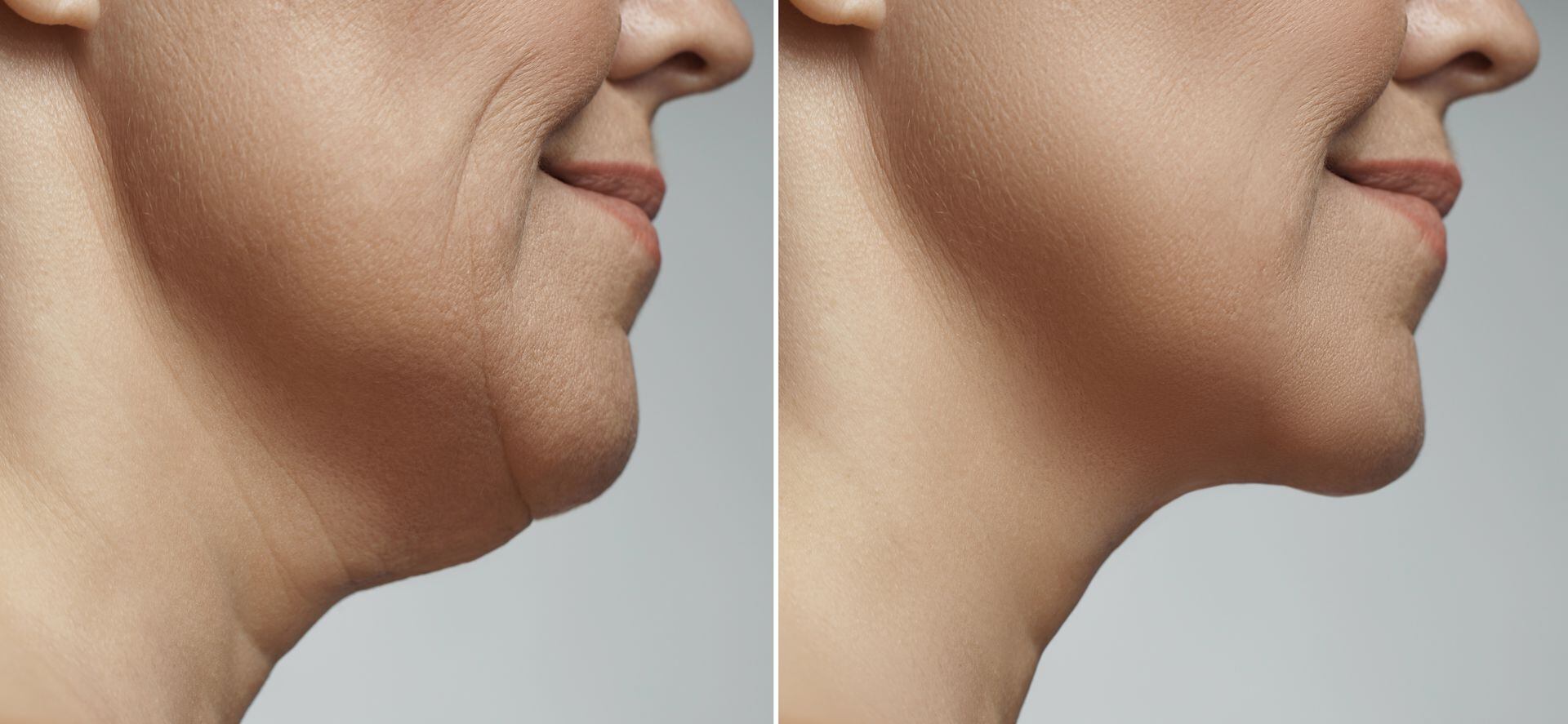 Cómo definir la mandíbula y rostro eliminando grasa facial - DOC