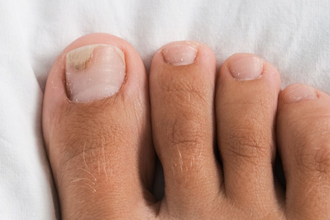Cómo usar el bicarbonato de sodio para eliminar los callos de los pies?