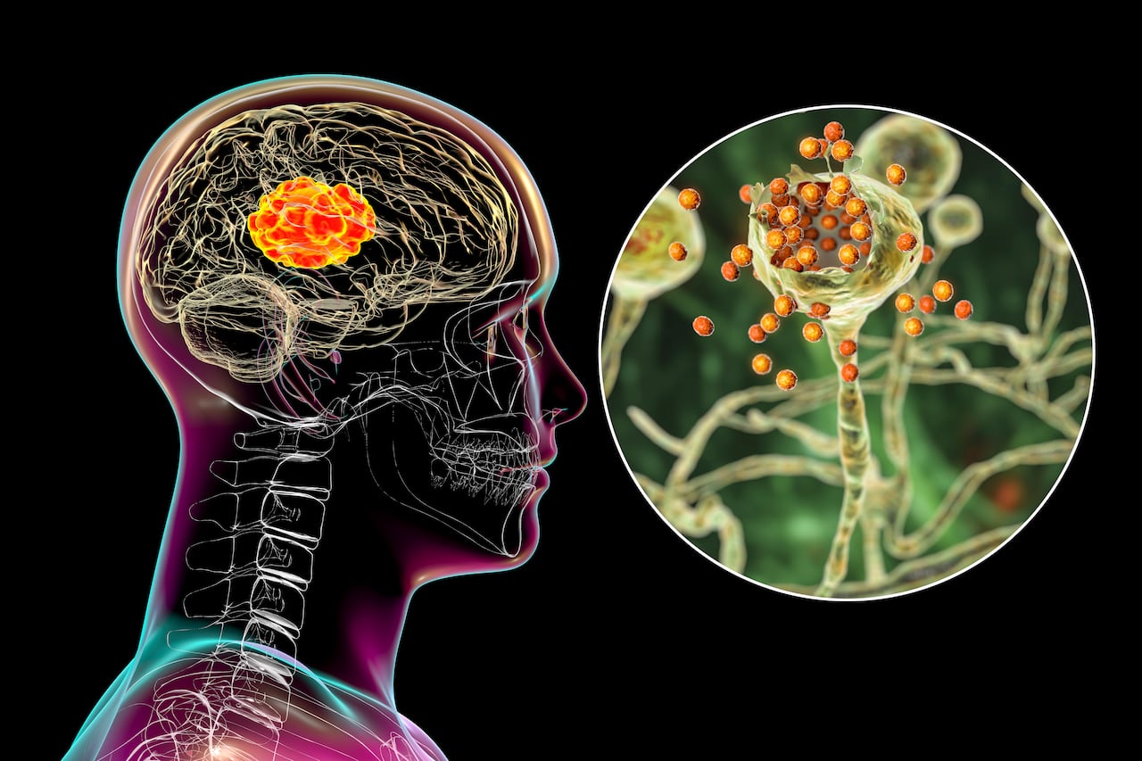 Algunos hongos cerebrales puede causar Alzheimer.