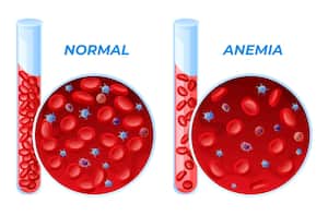 La anemia es una afección que se caracteriza por el nivel bajo de glóbulos rojos sanos.