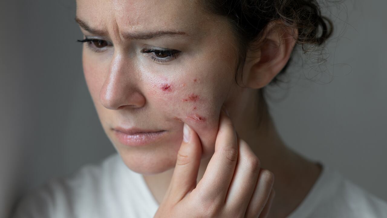 Cualquier persona puede sufrir de acné.