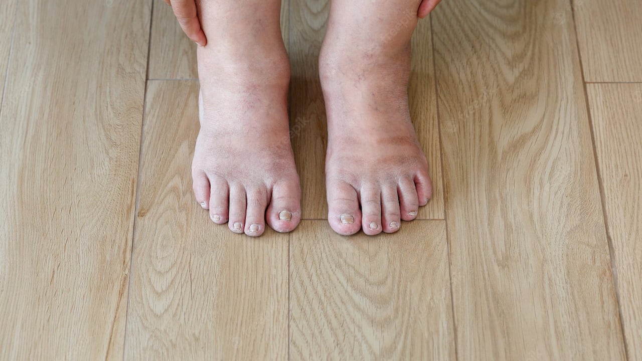 La hinchazón en piernas y pies afecta al tratamiento de la hipotensión. Por lo que los médicos recomiendan usar medias especiales para que la sangre circula y se regule.