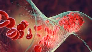 Los altos niveles de colesterol en la sangre es uno de los factores que más inciden en el taponamiento de las arterias.