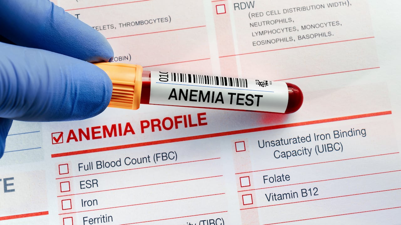 La anemia consiste en la deficiencia de glóbulos rojos.