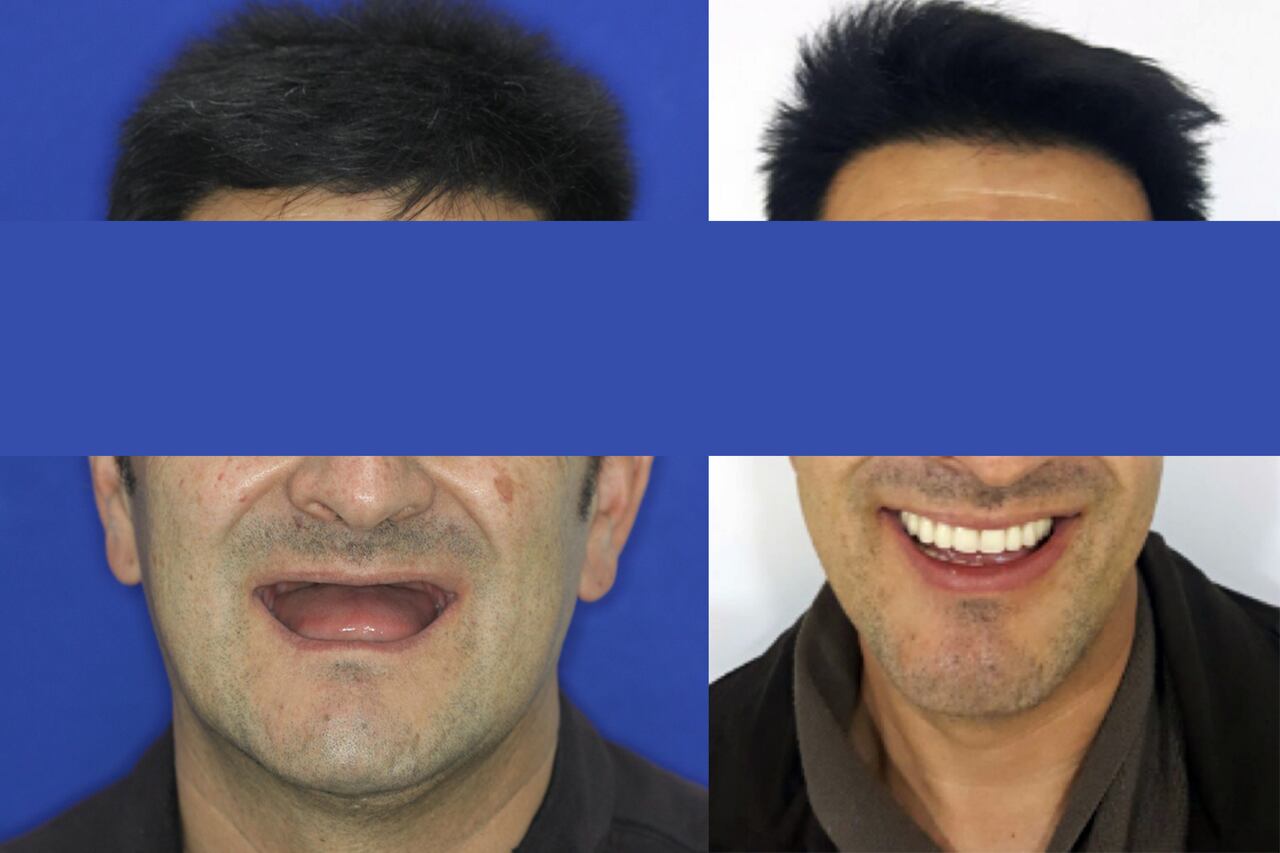 Con los implantes dentales también se recupera la estructura maxilar y se logra, entre otros beneficios, una apariencia más joven.