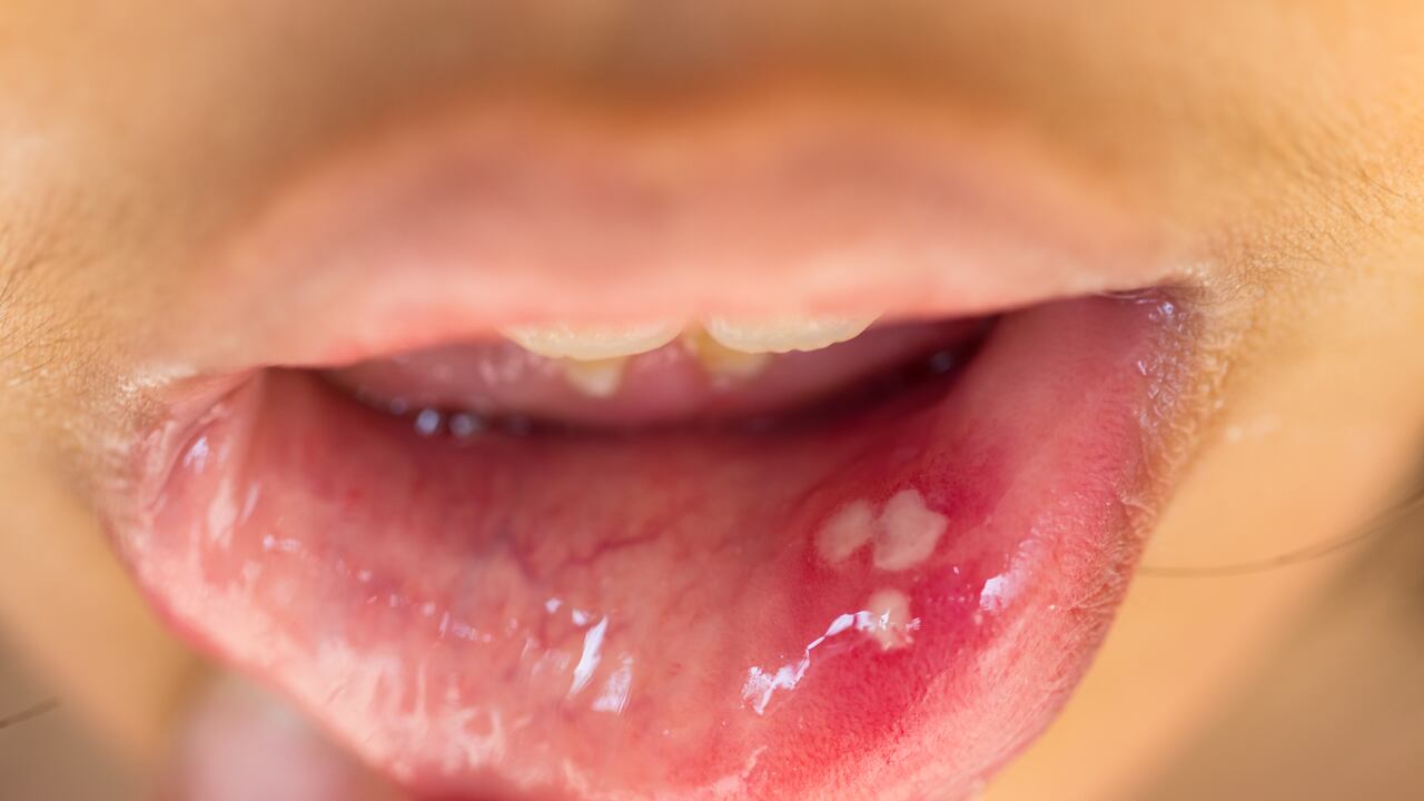 Úlcera bucal.

Mouth ulcer or canker sore or aphthous stomatitis or  aphthous ulcer