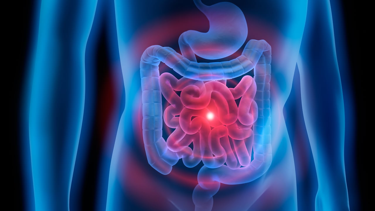 Una de las principales afectaciones del intestino grueso es el llamado colon irritable.