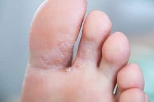 Los hongos en los pies pueden prevenirse adoptando algunas medidas higiénicas.