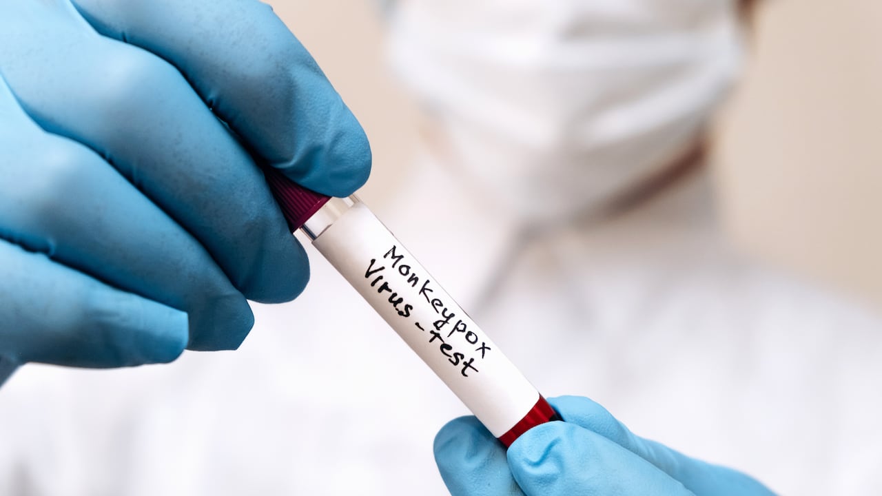 Un trabajador médico sostiene un tubo de ensayo con una muestra de sangre infectada con el virus de la viruela del mono en sus manos