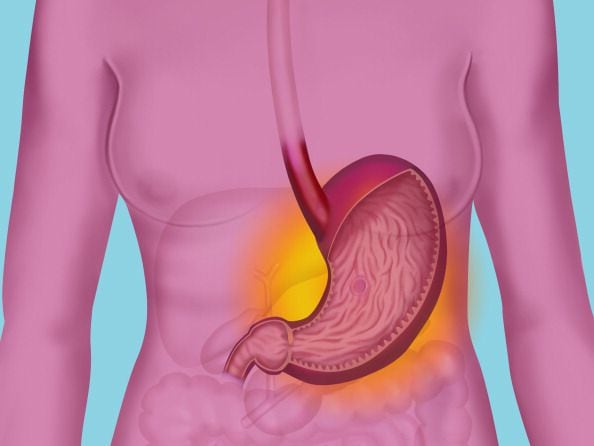 Gastritis is a group of diseases that share a common feature of inflammation of the stomach lining, which is caused by the same bacterial infection and is caused by most stomach ulcers, regular use of certain pain medications and even consumption of alcoholic beverages.  (BSIP/UIG image via Getty Images)